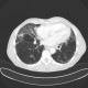 Lung fibrosis, basal: CT - Computed tomography